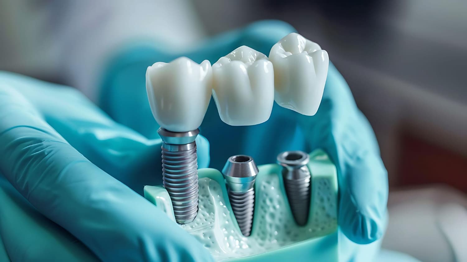 Dental Implants